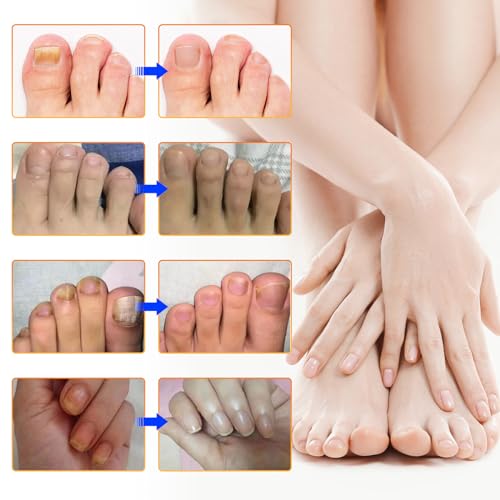 Toenail Treatment Extra Strength, 32 PCS Nail Patches 8-Hour Overnight Nail Repair Effortless Hydrogel Nail Care and Repair for Damaged Nails Overnight Renewal for Men and Women